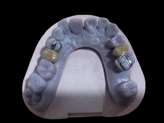 Αγορά Υψηλής ακρίβειας PFM Crown Dental Alloy Ni Free Metal Πορσελάνη Κρόνες ηλεκτρονική κατασκευή