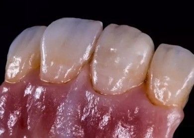 Γερμανικό Amanjilbach Zirconia οδοντικό στέμμα υψηλή πυκνότητα με προσαρμογή