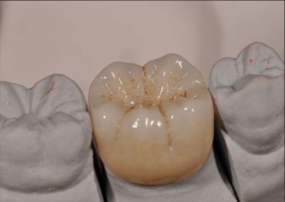 Υψηλή αισθητική Noritake Zirconia φυσικό χρώμα Σταθερό για πλήρη Zirconia Crown